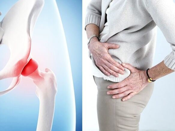 Symptoms of hip arthritis