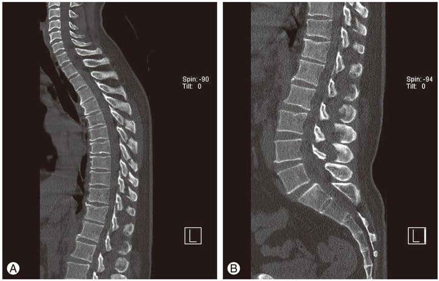 Deformation of the intervertebral disc in MRI images of thoracic osteochondrosis