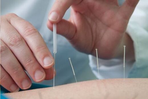 Acupuncture - a treatment for low back pain caused by osteochondrosis