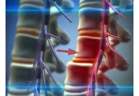 Lumbar osteochondrosis compresses nerve endings