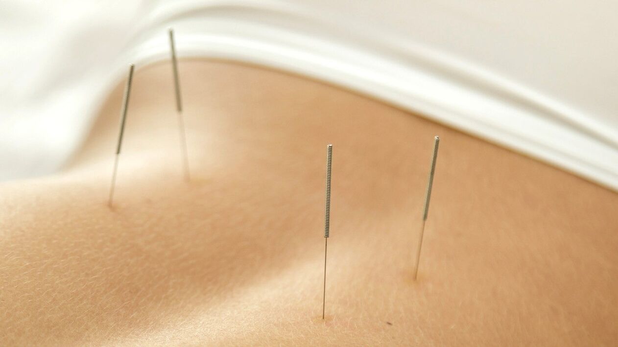 Acupuncture helps eliminate lower back pain