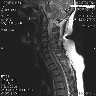 Osteochondrosis cervical spondylosis of the vertebral column